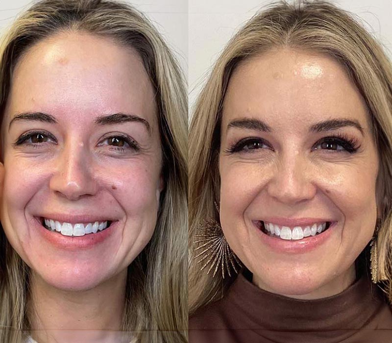 Botox11