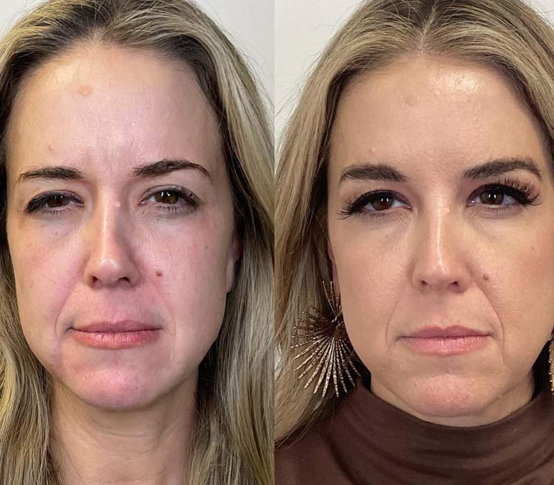 Botox12