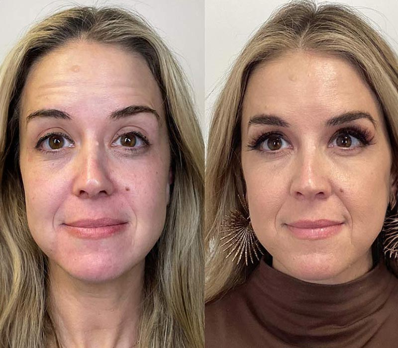 Botox21