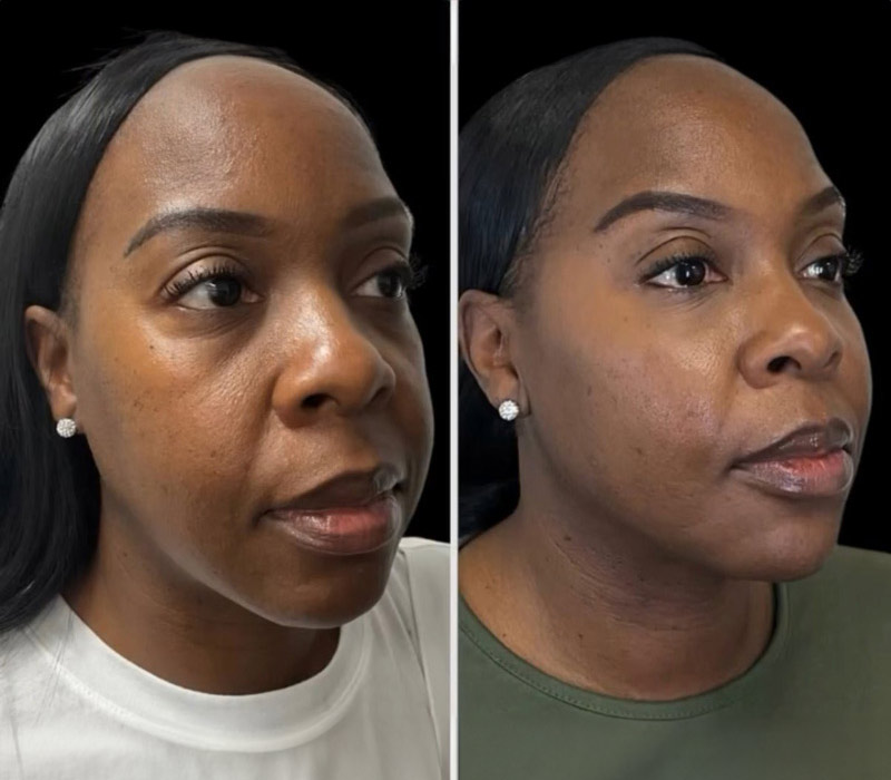 Cheek,-Jawline-and-Chin-Filler1