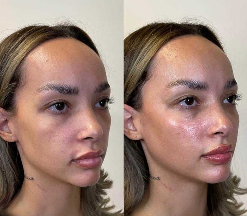 Full-facial-Balancing1