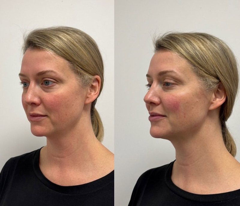 Full-facial-balancing-_before-and-after