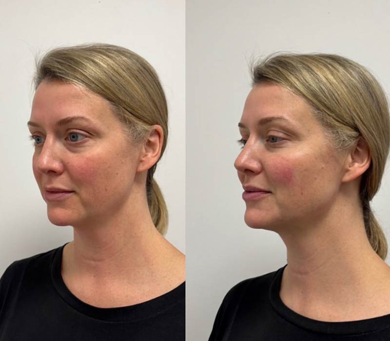Full-facial-balancing-_before-and-after1