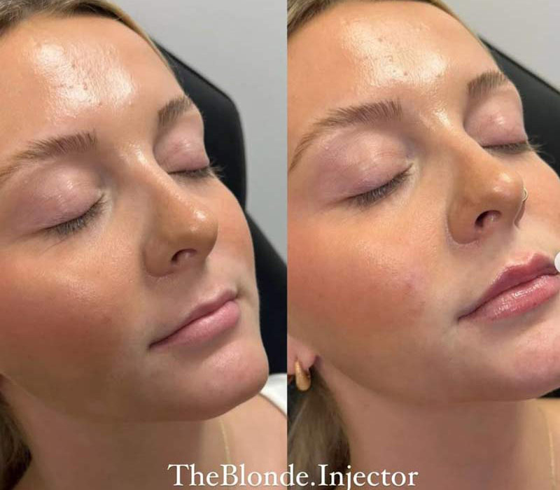 Lip-Filler-(1)1