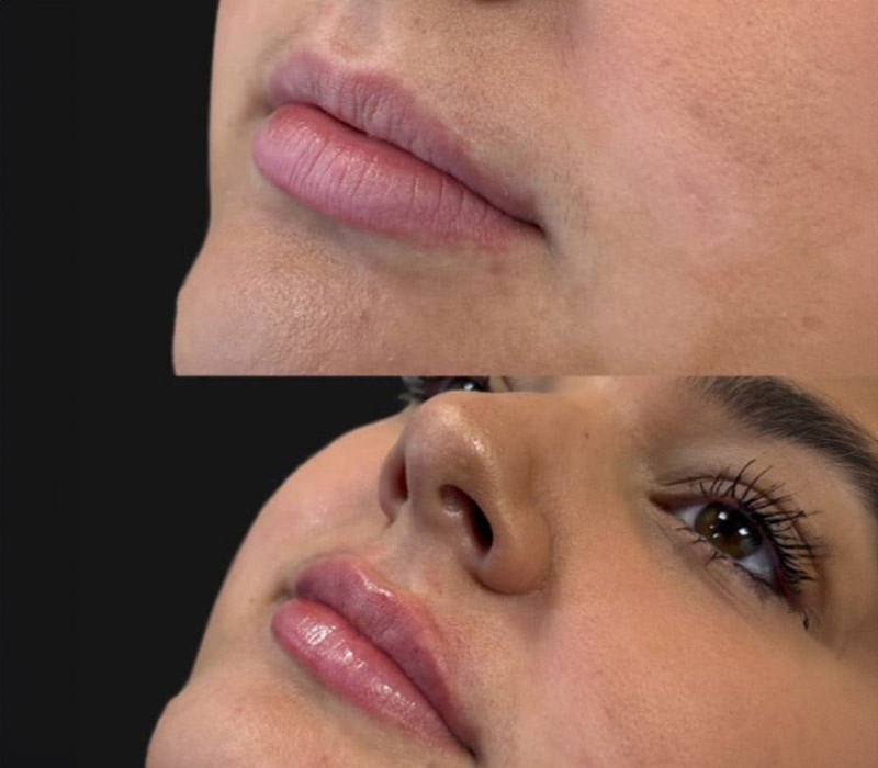 Lip-filler1
