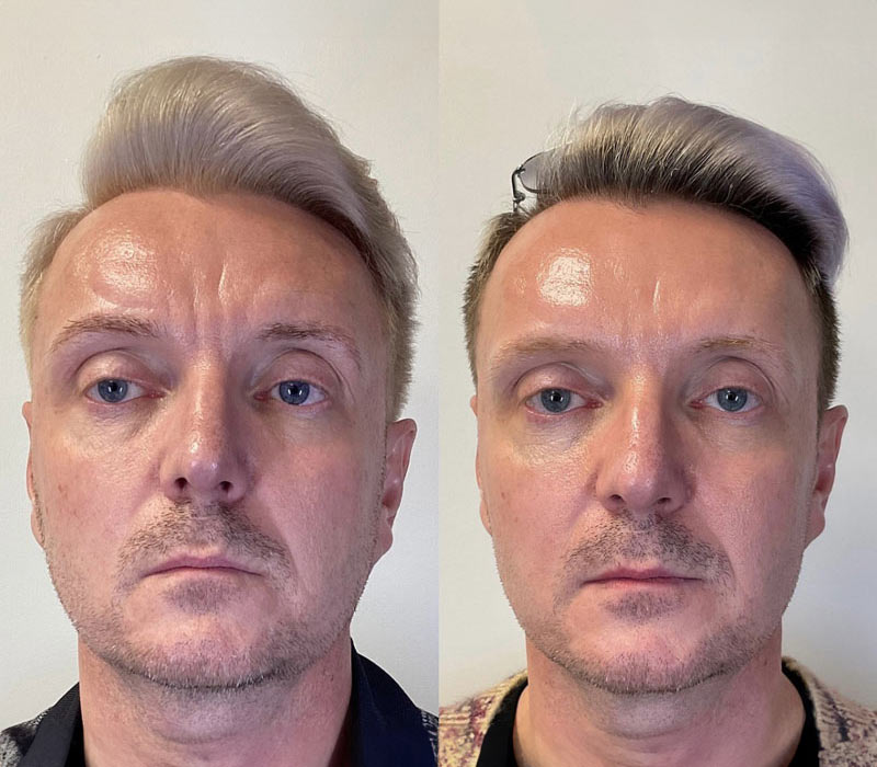 Microneedling-and-Botox1
