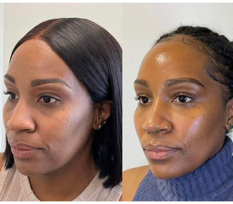 Undereye-filler2u