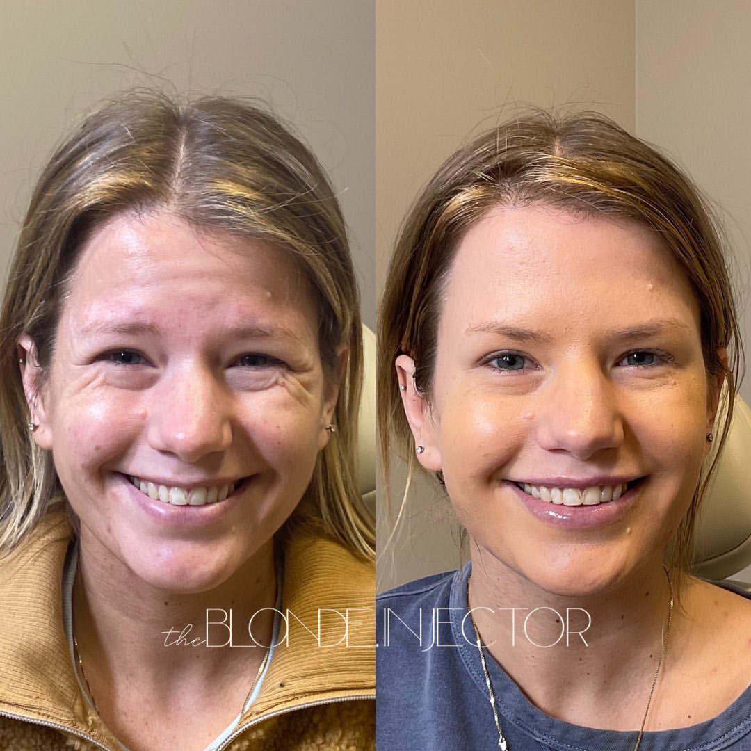 Botox and lip filler