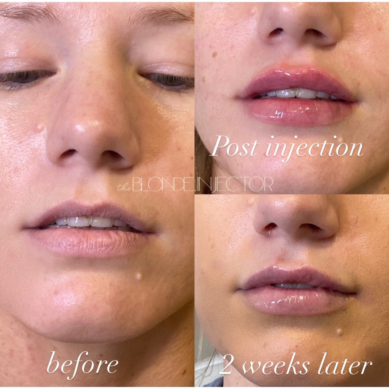 best lip filler atlanta
