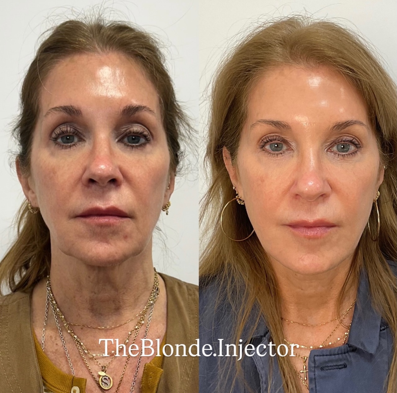 facial balancing