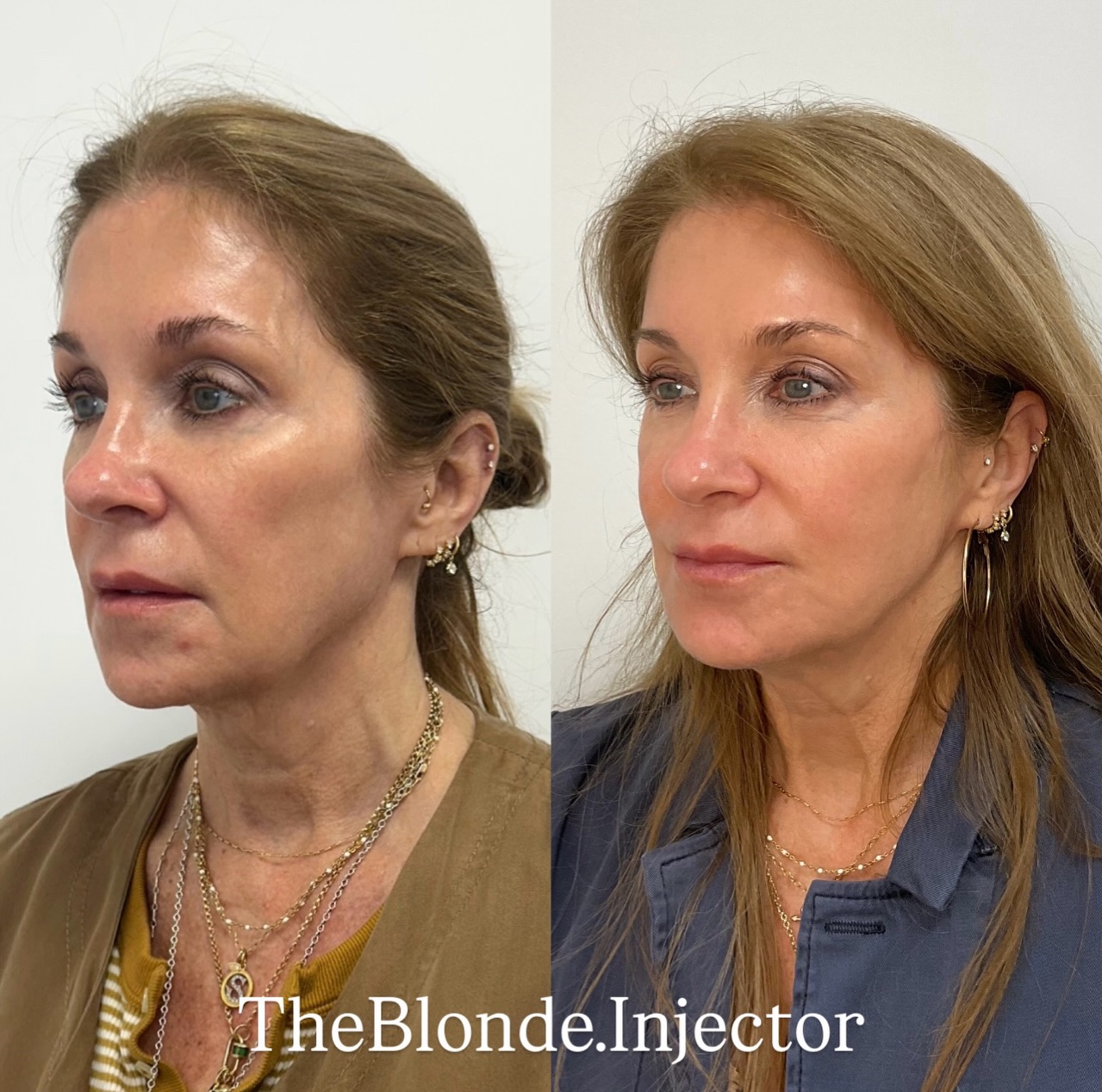 facial balancing 2