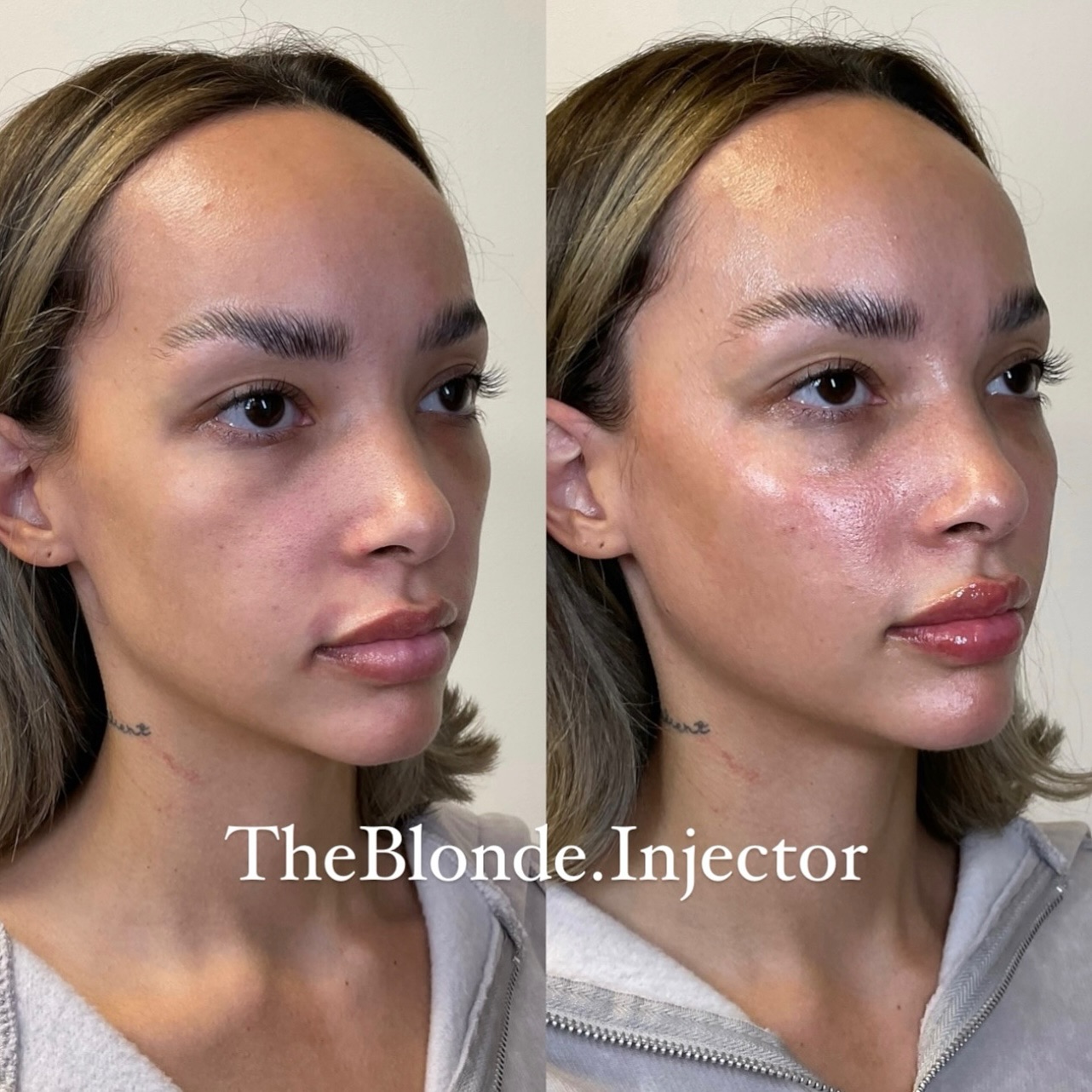 lip filler atlanta